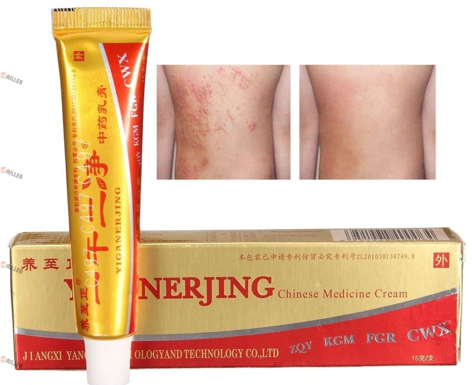 Chinese Dermatitis Psoriasis Cure Cream That’s Effective
